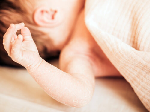 sudden infant death syndrome